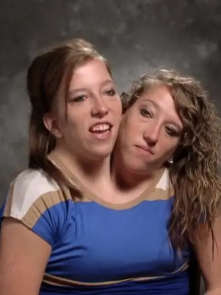 连体姐妹花:艾比和布列塔尼